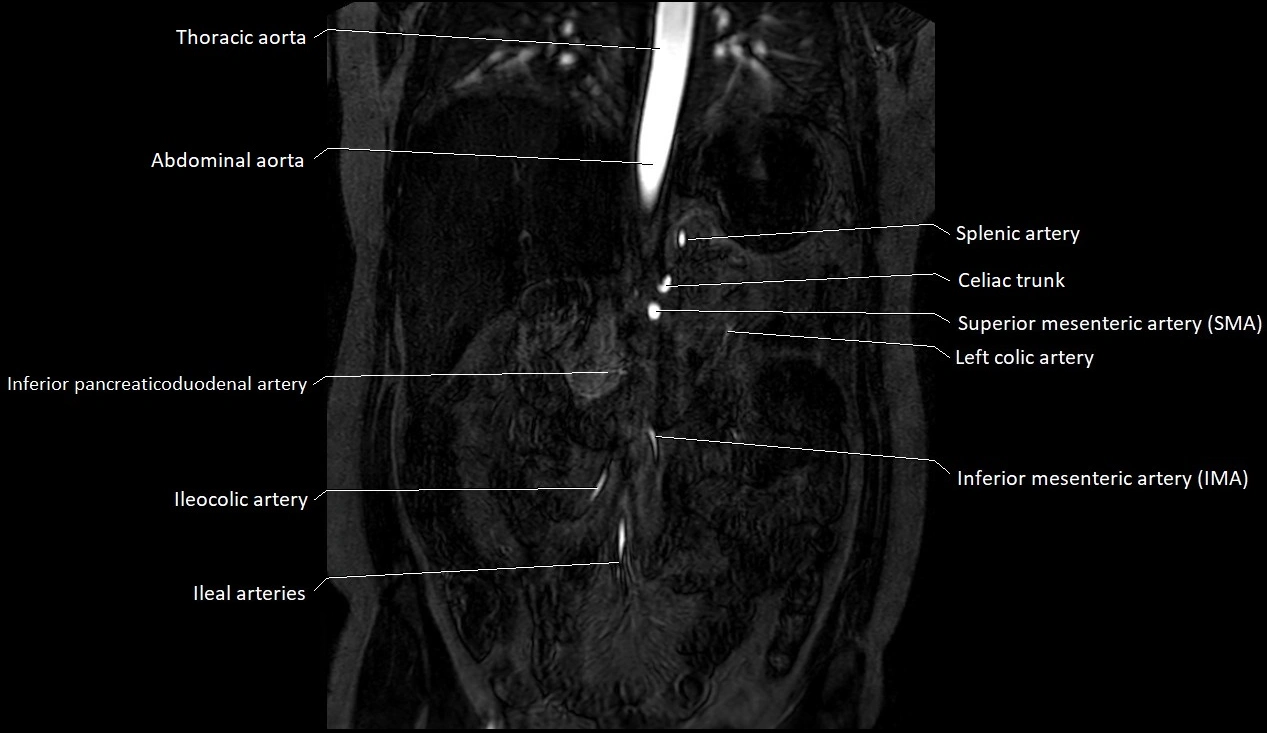 MRA Abdomen coronal anatomy image 15.webp